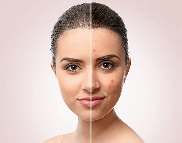 Acne-Scar-Treatment-in-Pune