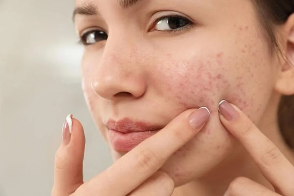 Acne Treatment in Pune