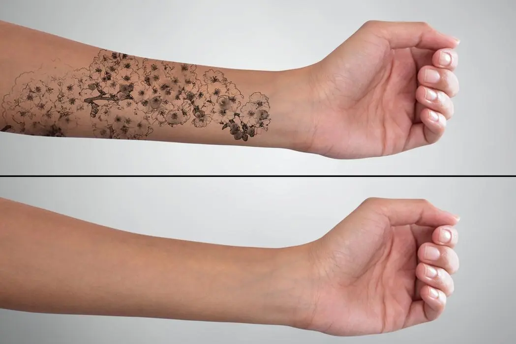 PicoMAX Laser Tattoo Removal at Perfect Skin Solution