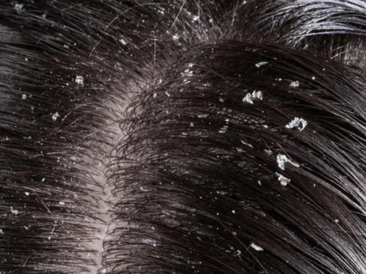How does dandruff get diagnosed