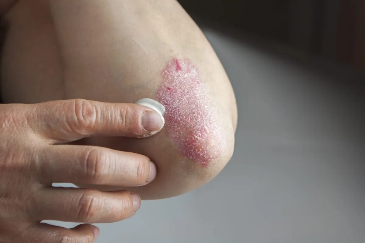 Psoriasis treatment in Pune at Bodysutra Clinic