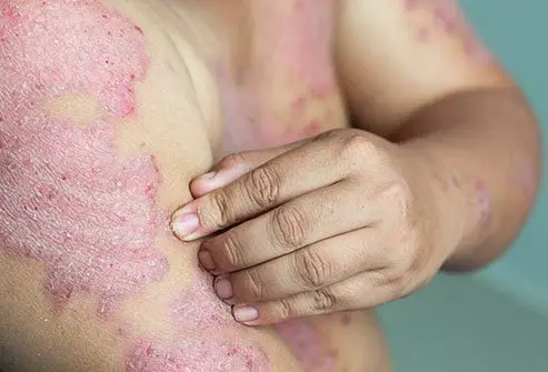 Psoriasis treatment in Pune