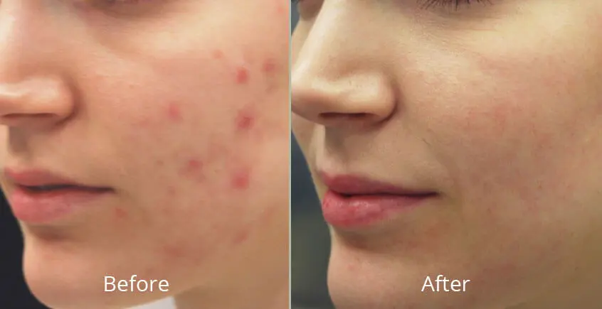Skin Polishing before and after