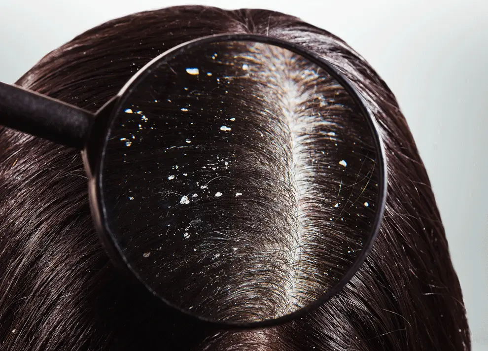 a girl is having dandruff in her head