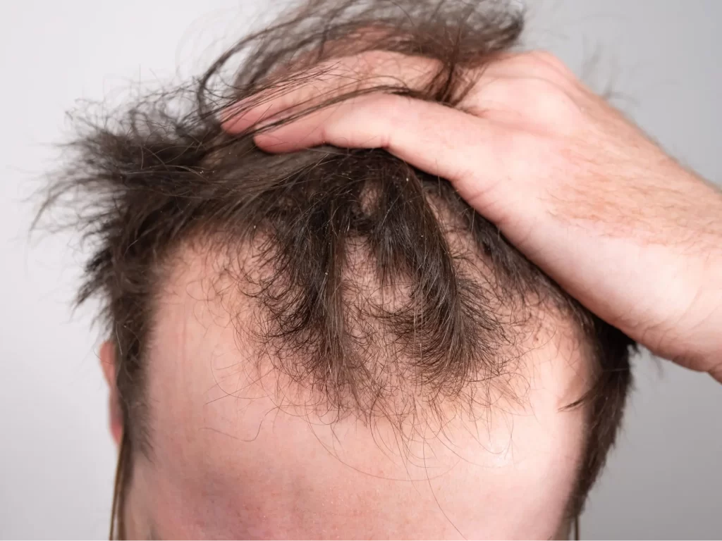 a man is facing hair loss
