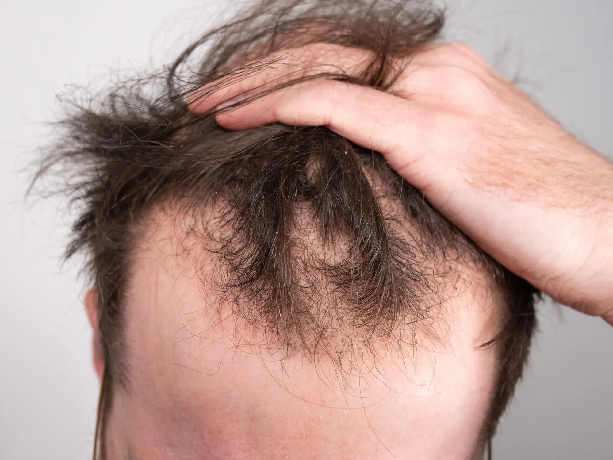 Advanced Skin Clinic in Pimple Saudagar for Skin & Hair Treatments 13 Pattern hair loss treatment for men and women