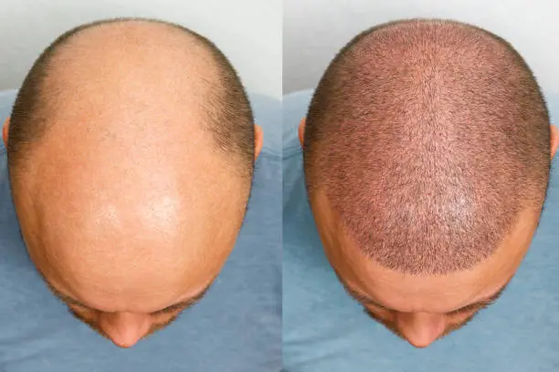 benefits of a hair transplant