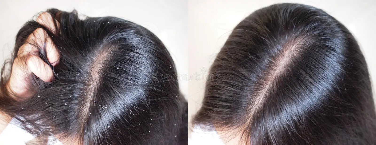 dandruff treatments available at the Bodysutra Clinic