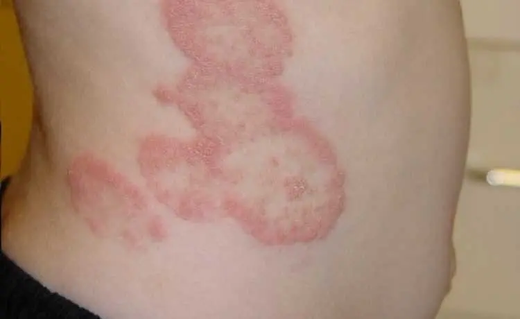 Fungal Infection Treatment in Pune