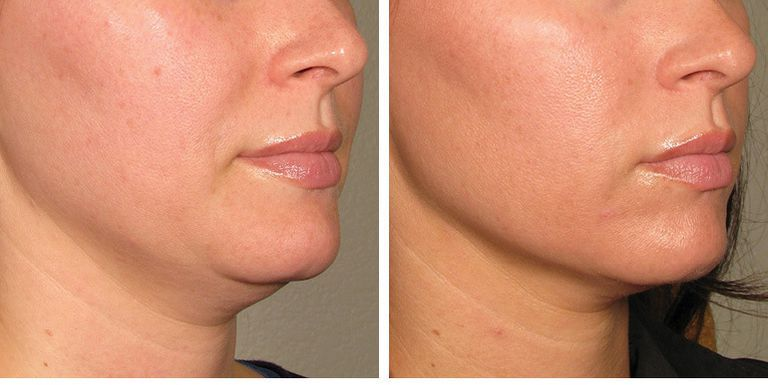 Skin Tightening Treatment in Pimpri Chinchwad 1 image2 4