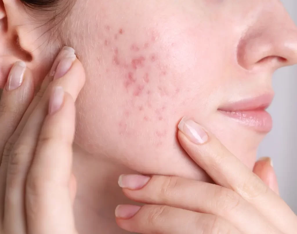Blog 82 Hormonal Acne How to Balance Your Skin During Hormonal Changes- fetaured image