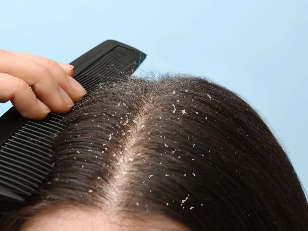 Advanced Skin Clinic in Pimple Saudagar for Skin & Hair Treatments 11 Dandruff and itchy scalp treatment