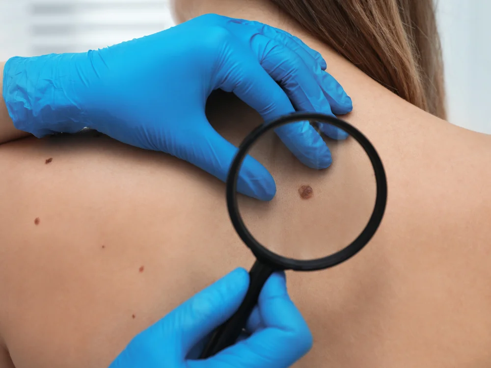 Advanced Skin Clinic in Pimple Saudagar for Skin & Hair Treatments 9 Mole and wart care