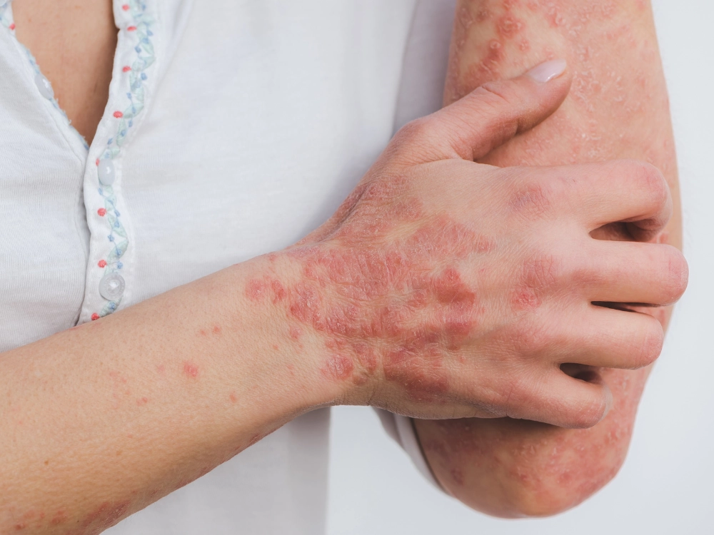 Advanced Skin Clinic in Pimple Saudagar for Skin & Hair Treatments 4 Psoriasis care