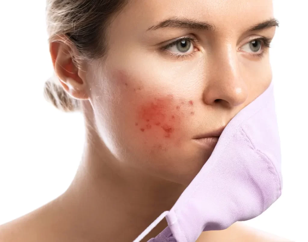 Blog 80 Acne Mechanica Explained Tips for Athletes and Active Individuals- featured image