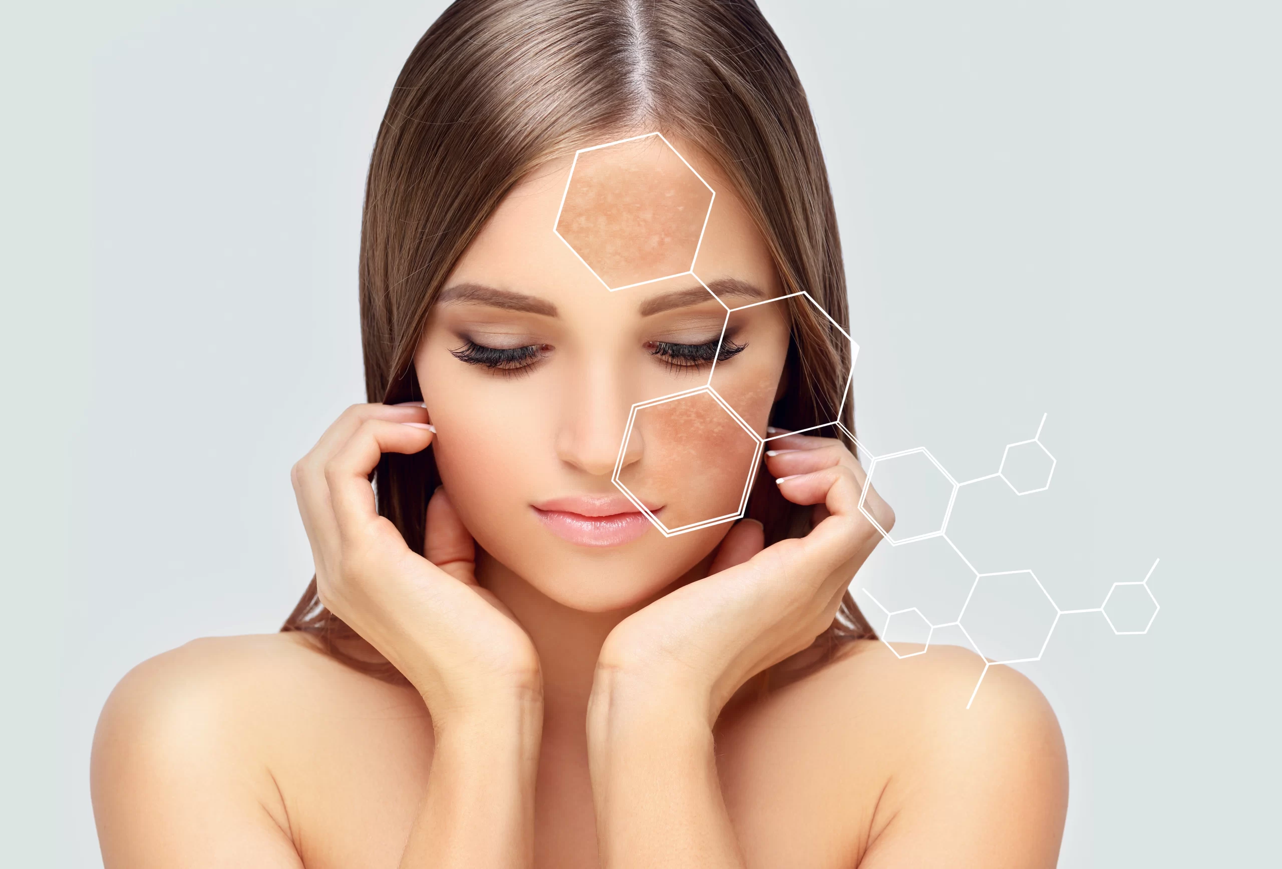 Melasma vs Hyperpigmentation: What’s the Difference?