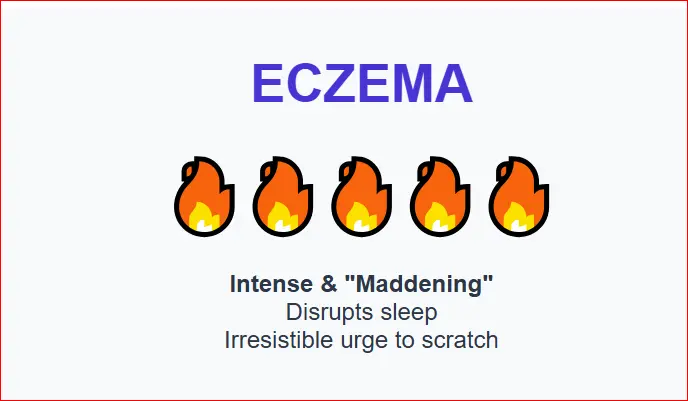 Eczema severity illustration showing five burning icons indicating intense itching, sleep disruption, and an irresistible urge to scratch