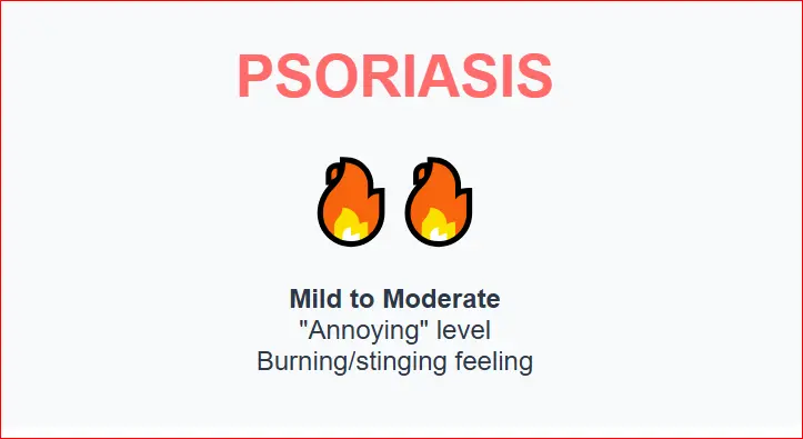 Psoriasis severity chart showing two burning icons indicating mild to moderate discomfort with stinging or burning sensation