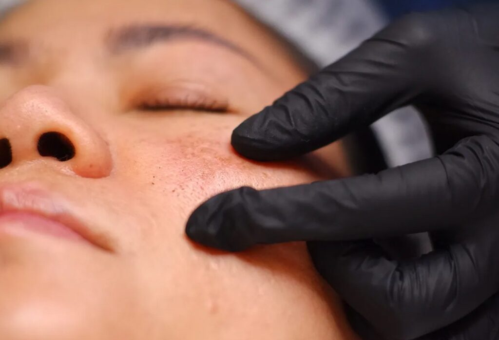 Blog 70 Pigmentation and Age Spots