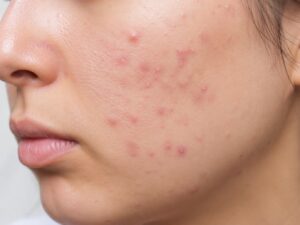 Blog 74 Acne-Prone Skin