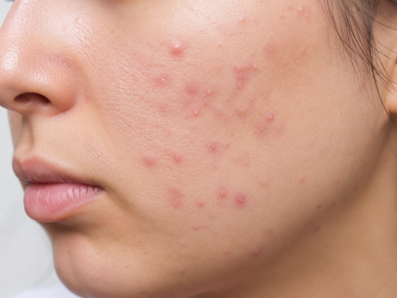 Hormonal Acne: How to Balance Your Skin During Hormonal Changes 8 Acne-Prone Skin