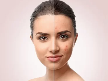 Acne-Scar-Treatment-in-Pune