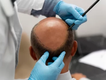 Hair Patch
